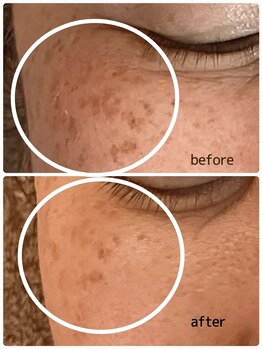 エステティックジュビラン アンビエンテ 福井南店/シミケア