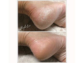 ミューベル(MYubelle)/かかと乾燥ケア 水光ピーリング