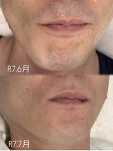 アトリエバンビ(atelier Bambi)/メンズ・ひげ脱毛＊