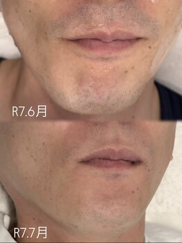 アトリエバンビ(atelier Bambi)/メンズ・ひげ脱毛＊