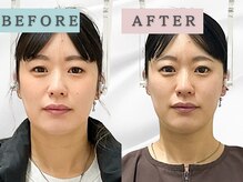 エルシンメトリー矯正院(ailesシンメトリー矯正院)/before＆after　ailes式小顔矯正