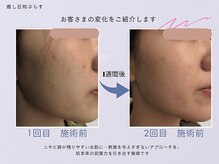 癒し日和ぷらす/よもぎ蒸し×酵素フェイシャル