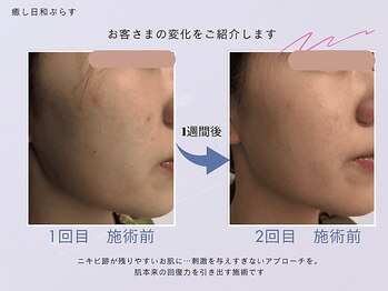 癒し日和ぷらす/よもぎ蒸し×酵素フェイシャル