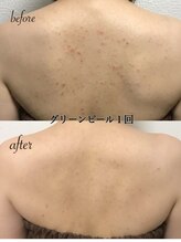 バービーフェイス 恵比寿(Barbie Face)/グリーンピールブライダルケア