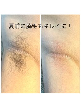 ココリ(CoCoRe)/wax脱毛　脇