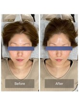 ハリ トモカ 南浦和サロン(HARI TOMOKA)/美容鍼