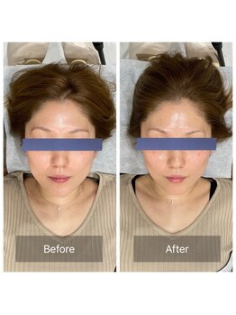 ハリ トモカ 南浦和サロン(HARI TOMOKA)/美容鍼