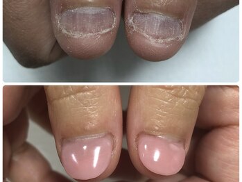 ブルームーンネイルズ(BLOOMOON.nails)/即日で見た目改善！