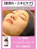 赤み、凸凹、肌荒れ、ニキビ改善フェイシャル    ￥8,800