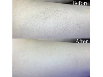 ハイリー(Hily)/膝上 before、after