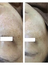 エヴァーグレース 河原町店/京都河原町の毛穴改善美肌サロン