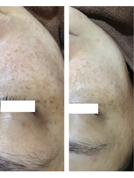 エヴァーグレース 河原町店/京都河原町の毛穴改善美肌サロン