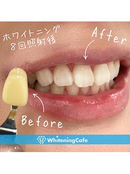 ホワイトニングカフェ 熊本店(WhiteningCafe)/◎歯のホワイトニング症例写真◎
