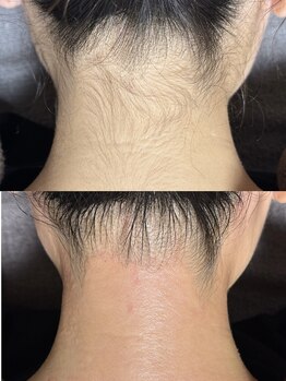 エステ リラクゼーションサロン(more)/うなじ・えりあしWAX脱毛