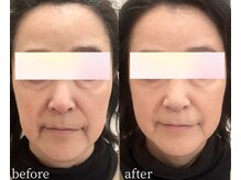 マーリィズエステティック(MARLEY'S AESTHETIC)の雰囲気（サークルショットでフェイスラインのぼやけ、たるみ解決！）