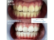 ホワイトニングサロン 熊本店/セルフホワイトニング