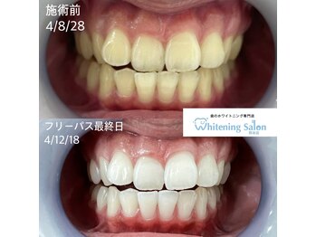 ホワイトニングサロン 熊本店/セルフホワイトニング