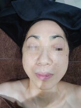 ボーソリューション(Beau-Solution)/【50代まるでヒアルロン酸注入】