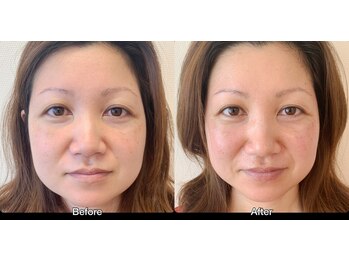 まこと鍼灸院/美容鍼の即効性ビフォーアフター