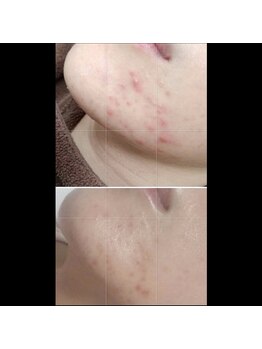 ルヴィショップ 沖縄(REVI SHOP)/SNSで話題のハーブピーリング