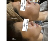 エレナ(Elena)/陶肌トリートメント