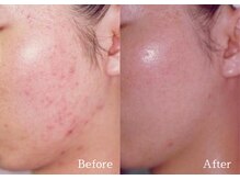 綺麗サロン 脱毛アンドフェイシャル ジュエル(Jewel)/【4BミネラルクリアTR】