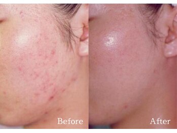 綺麗サロン 脱毛アンドフェイシャル ジュエル(Jewel)/【4BミネラルクリアTR】