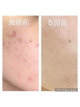 エムローズ(M.rose)/ニキビケア・予防☆