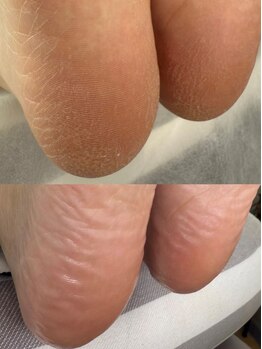 ヴィエル ネイル(VIEL NAIL)の写真/削るだけじゃない！【韓国式足裏角質スペシャルケア】で長年蓄積したかかとの角質をごっそり除去☆