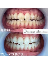 ホワイトニングサロン 京都烏丸店/ホワイトニング施術例