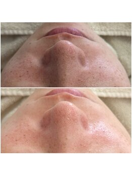 マヴィ くずは店(MavY.)/生まれ変わるお肌