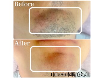 トータルメンズエステ キング(KING)/■電気脱毛■日焼け肌もOK