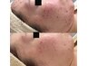【徹底ニキビケア★】ニキビケア×毛穴ケアのダブルケアでなめらかお肌へ…