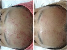 ルノン(LUNON)/ビフォーアフター集