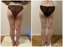 リリィブラン(Lily branc)/【痩身】ヒップ+太もも