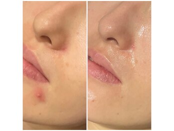 オリエンタルビューティー(ORIENTAL BEAUTY)/プラズマ×ハーブピーリング