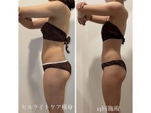 ヴィクシア(VIXIA)/痩身90分