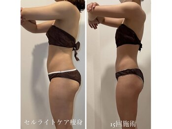 ヴィクシア(VIXIA)/痩身90分