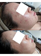 ミュー(Mieux)/自分の肌が好きになりました！