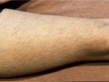 ヨハク(YOHAKU)/20代後半　男性　７回施術before