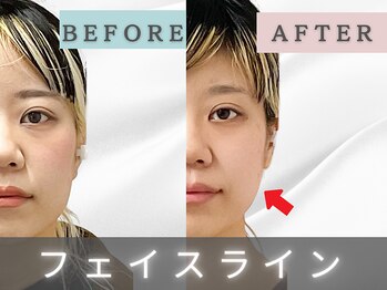 エルシンメトリー矯正院(ailesシンメトリー矯正院)/before＆after　ailes式小顔矯正