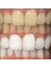 ホワイトニングセンター 京都長岡京店/長岡京・大山崎ホワイトニング