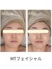 【目元・口元のゆるみが気になる方に】MT極上リフトフェイシャル