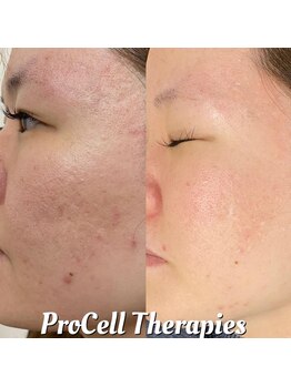 マーズ(Mars)/プロセル肌質改善トリートメント