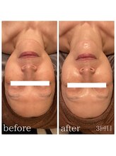 ソーレ(Sole)/《REVI》陶肌トリートメント