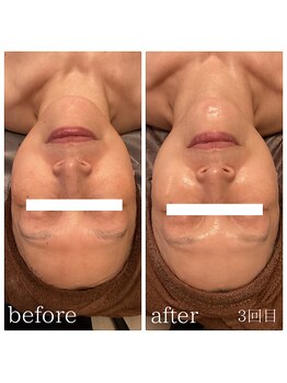 ソーレ(Sole)/《REVI》陶肌トリートメント