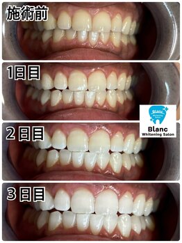 ブラン 心斎橋店(Blanc)/他店で白くならなかった方歓迎