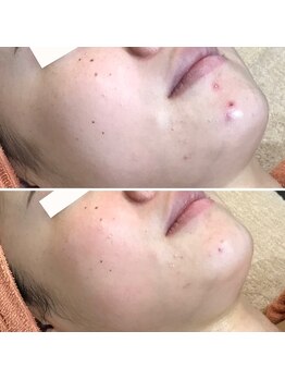 ヴィヴィ(ViVi)/肌質改善　HAAB REPROピーリング