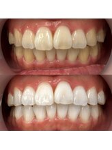 LBSホワイトニング 錦糸町店/ホワイトニングビフォーアフター