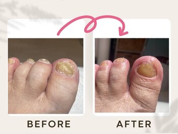 ドクターネイル爪革命 恵庭店/肥厚爪ケア